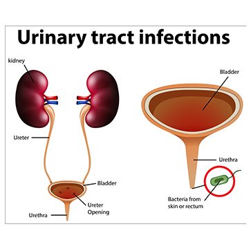 Urinary Tract Infection